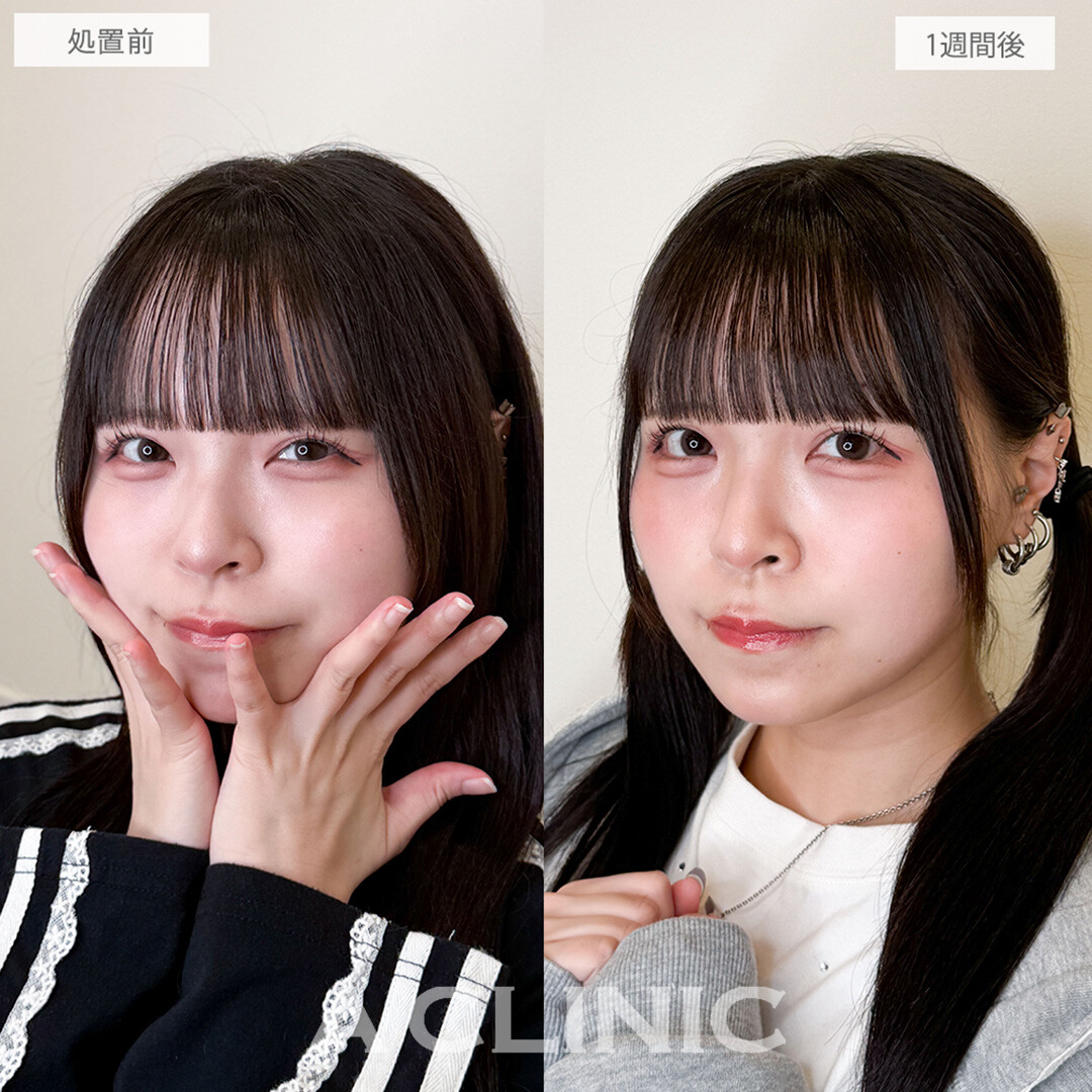 パーフェクトアイズで可愛い印象の丸目に！こちら処置前と1週間後の症例です(20代女性)