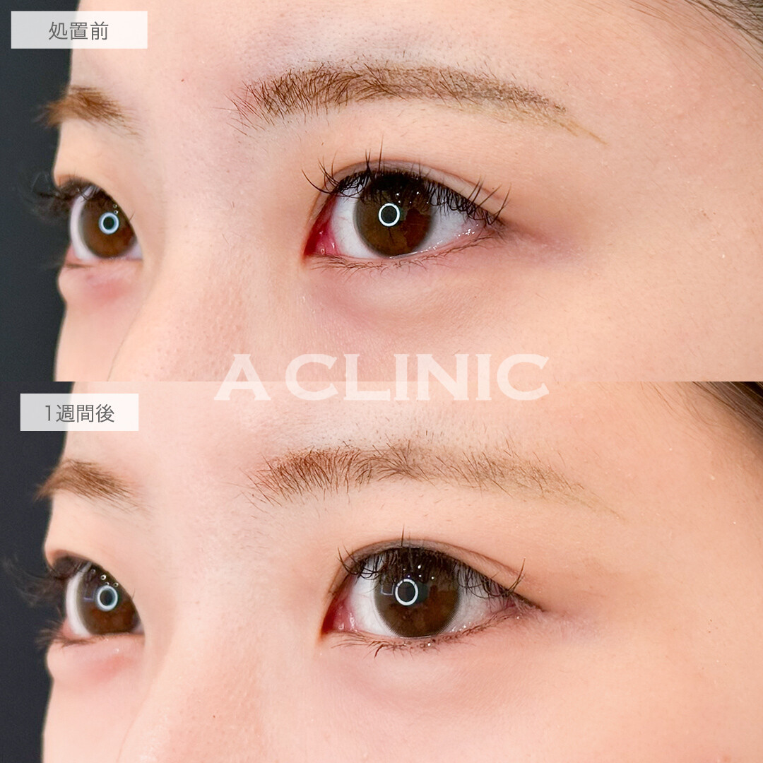 パーフェクトアイズでちゅるんと可愛いタレ目に！処置前と1週間後の症例です(20代症例)