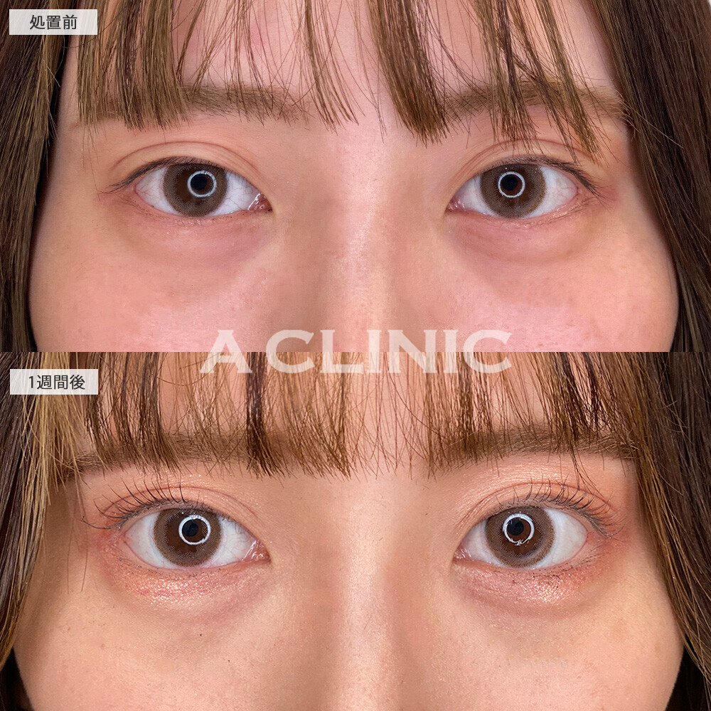 パーフェクトアイズで目力アップ！こちら処置前と1週間後の症例です(20代女性)