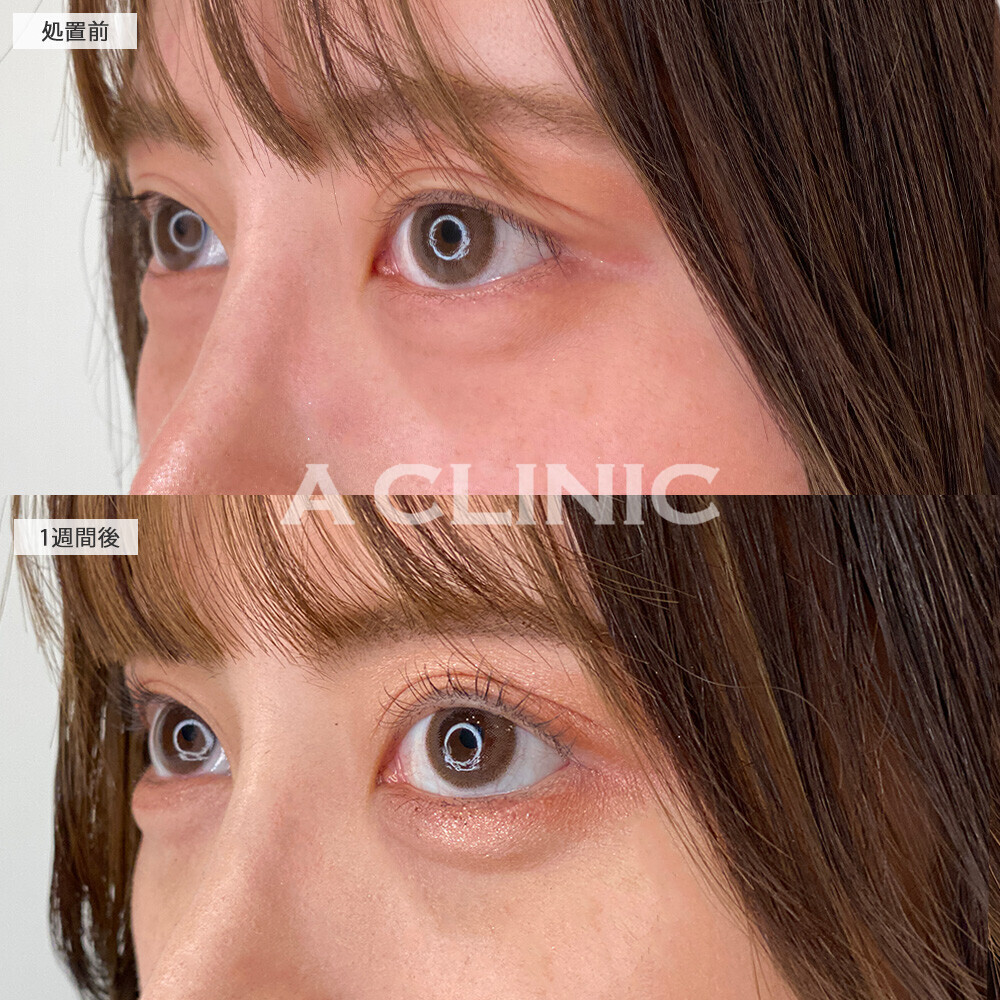 パーフェクトアイズで目力アップ！こちら処置前と1週間後の症例です(20代女性)