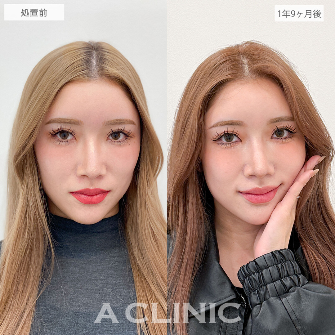 パーフェクトアイズで時間が経っても可愛い印象の目元に！こちら処置前と1年9ヶ月後の症例です(30代女性)