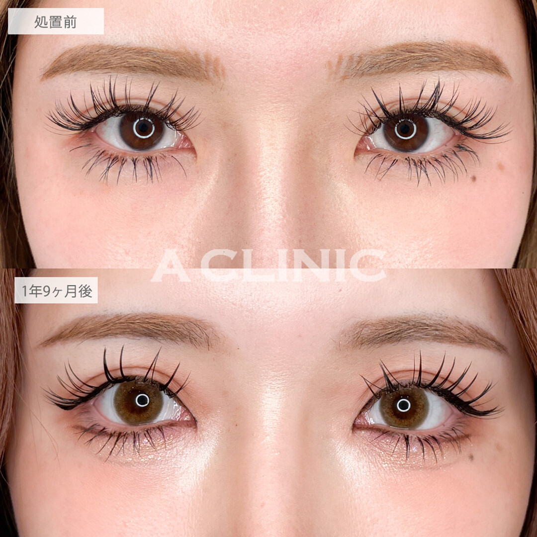 パーフェクトアイズで時間が経っても可愛い印象の目元に！こちら処置前と1年9ヶ月後の症例です(30代女性)