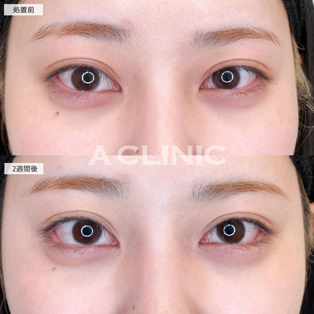 パーフェクトアイズで目の開きが良くなり目力UP！こちら処置前と2週間後の症例です(20代女性)