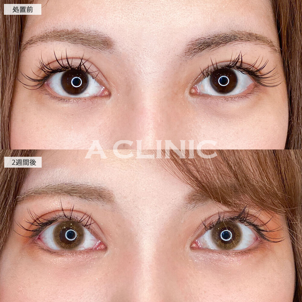 パーフェクトアイズで丸く優しい目元に！こちら処置前と2週間後の症例です(30代女性)