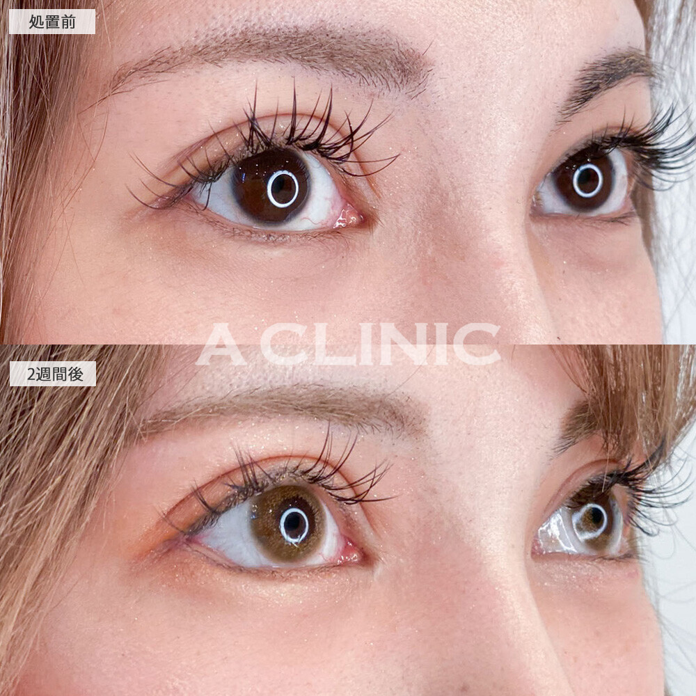 パーフェクトアイズで丸く優しい目元に！こちら処置前と2週間後の症例です(30代女性)