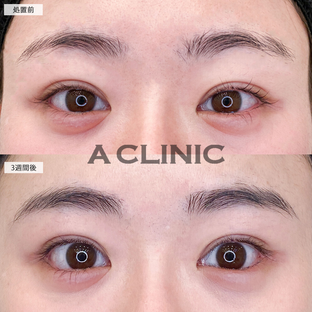 パーフェクトアイズで存在感のある大きな目元になりました！こちら処置前と3週間後の症例です(30代女性)