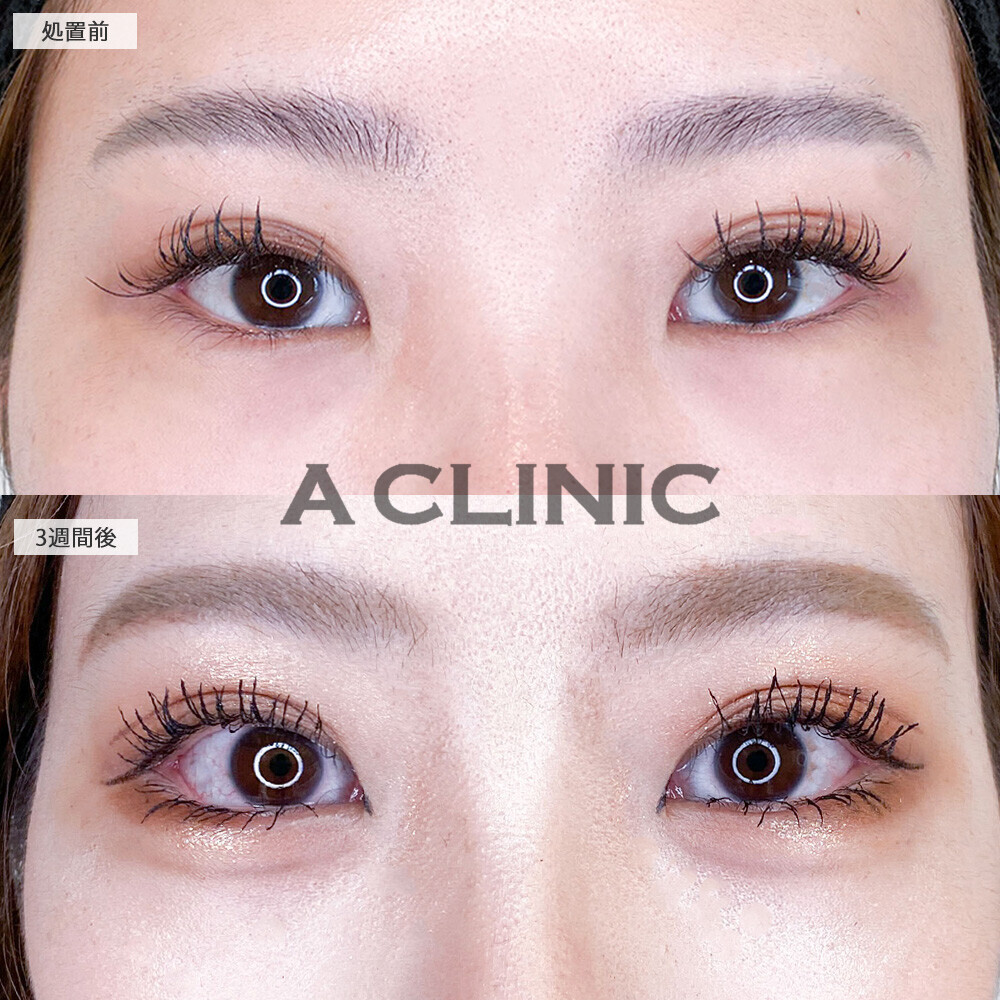 パーフェクトアイズで存在感のあるメイク映えする目元に！こちら処置前と3週間後の症例です(20代女性)