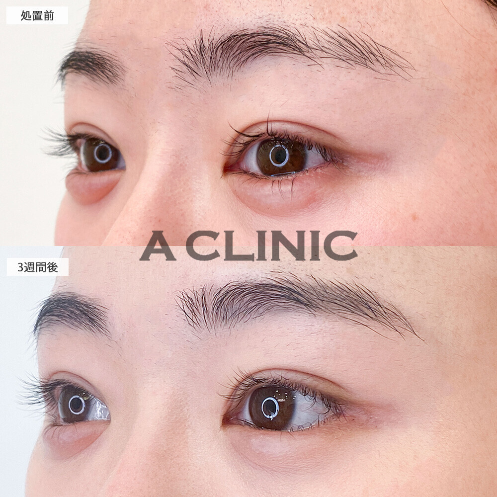 パーフェクトアイズで存在感のある大きな目元になりました！こちら処置前と3週間後の症例です(30代女性)