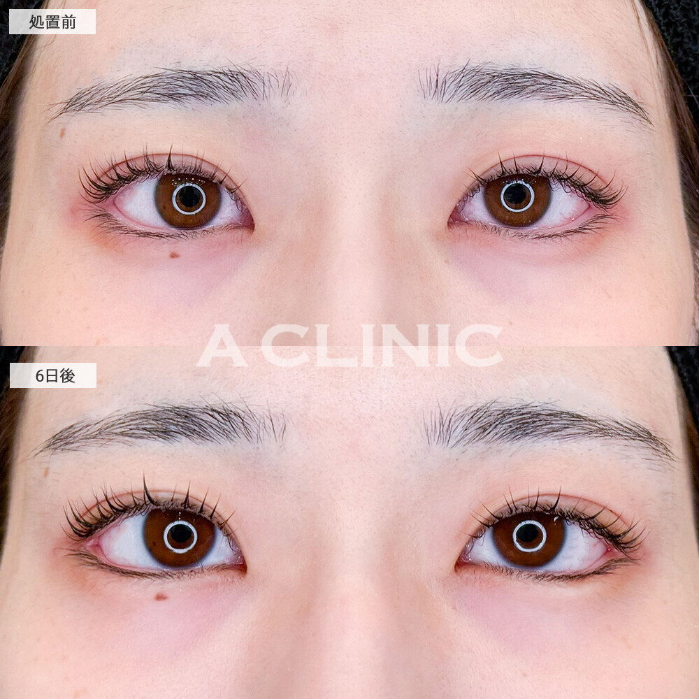 パーフェクトアイズでタレ目になり目の大きさもUP！こちら処置前と6日後の症例です(10代女性)