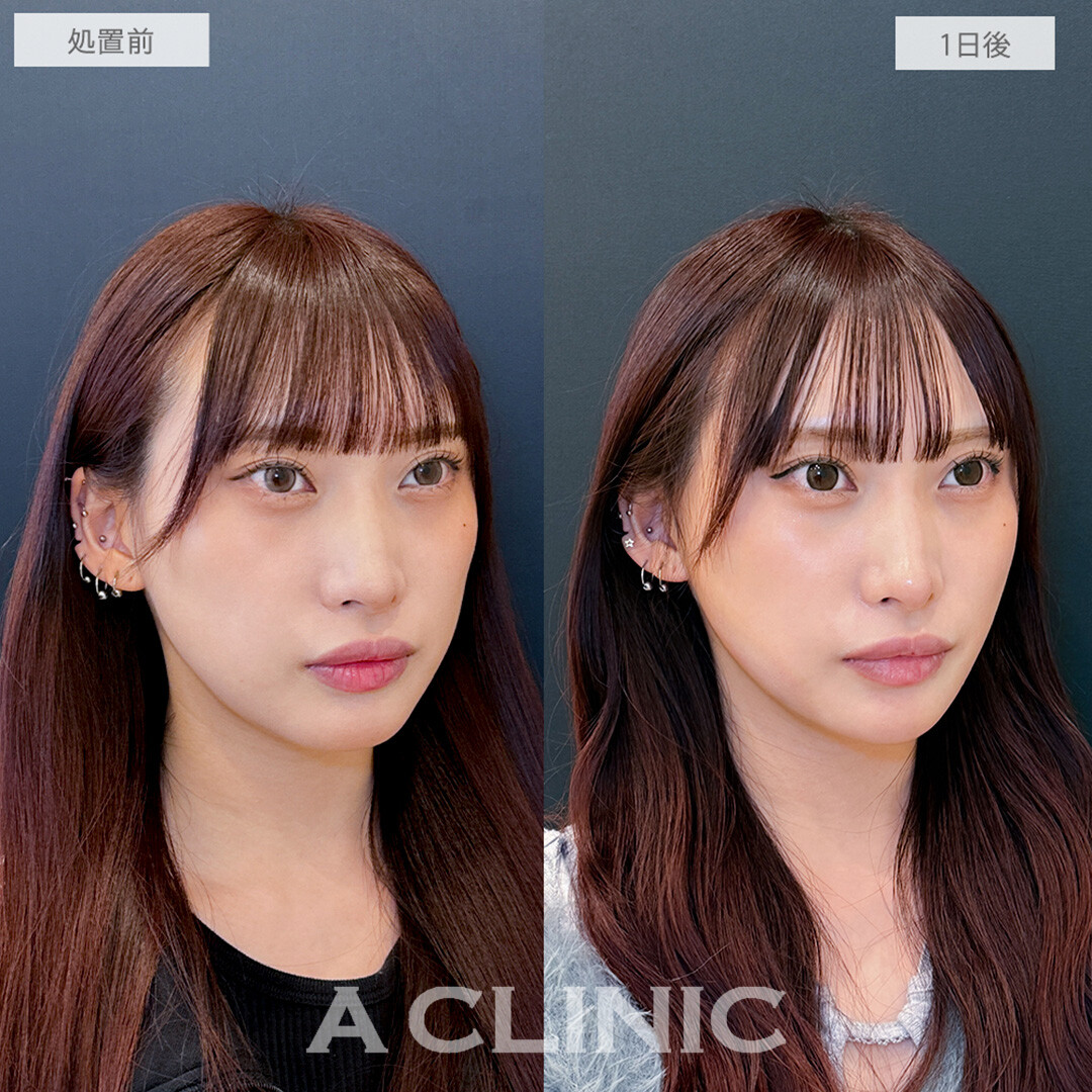 1day小顔脂肪吸引でフェイスラインが整いワンランク上の小顔に！処置前と1日後の症例です(20代女性)