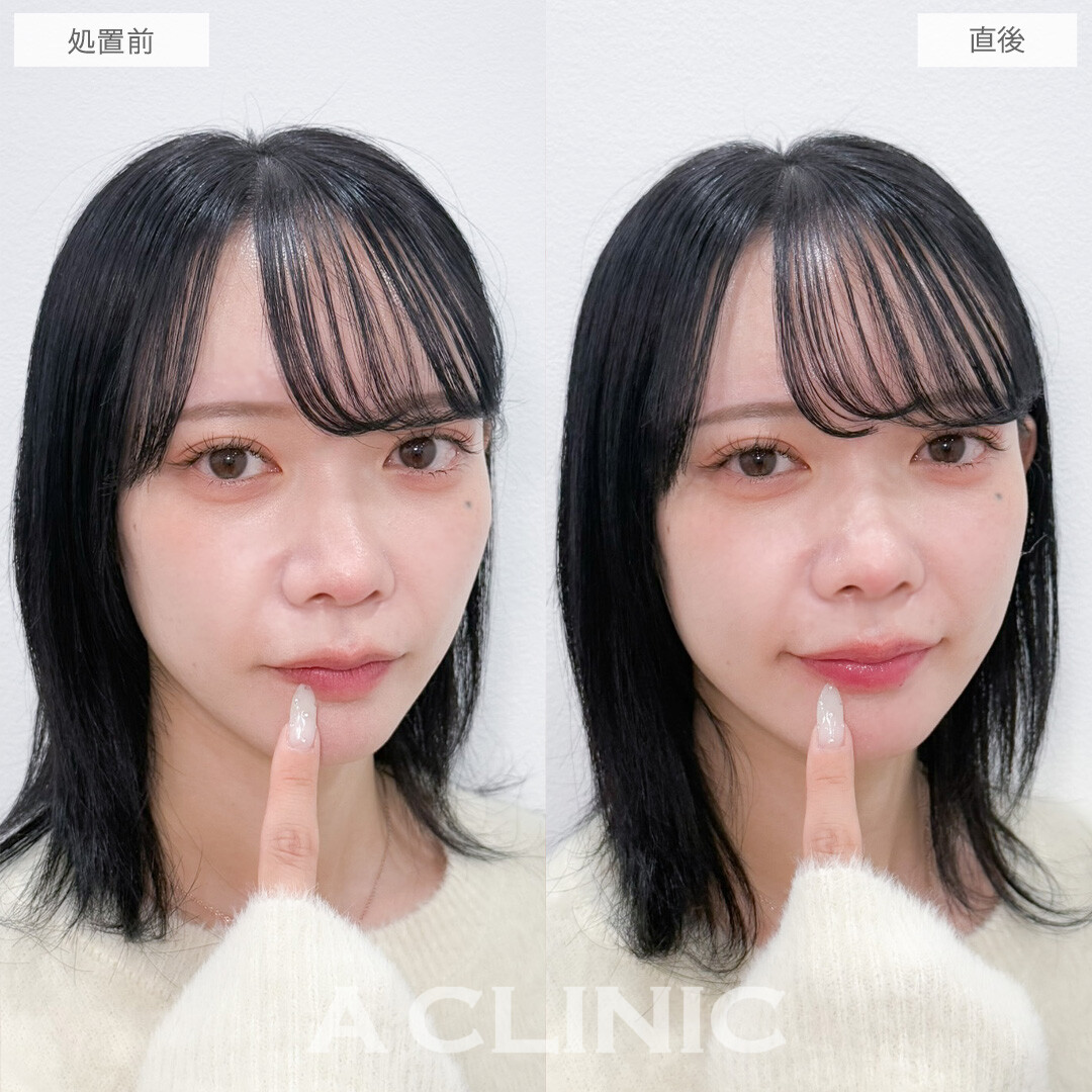 スマイルリップで存在感のあるぷるぷるリップに！こちら処置前と直後の症例です(30代女性)