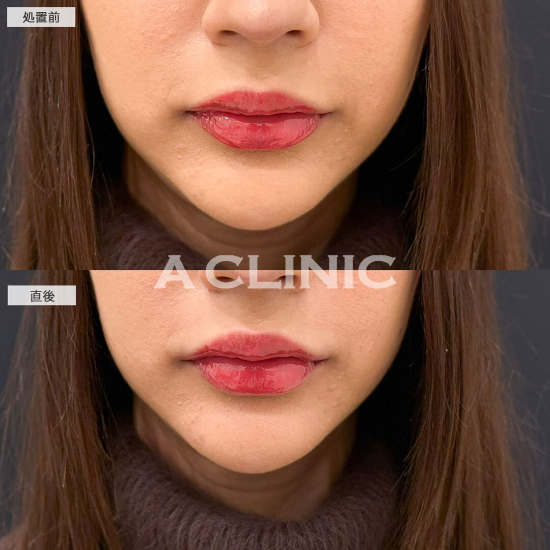 スマイルリップで口角がキュッと上がって可愛さレベルアップしました！こちら処置前と直後の症例です(20代女性)