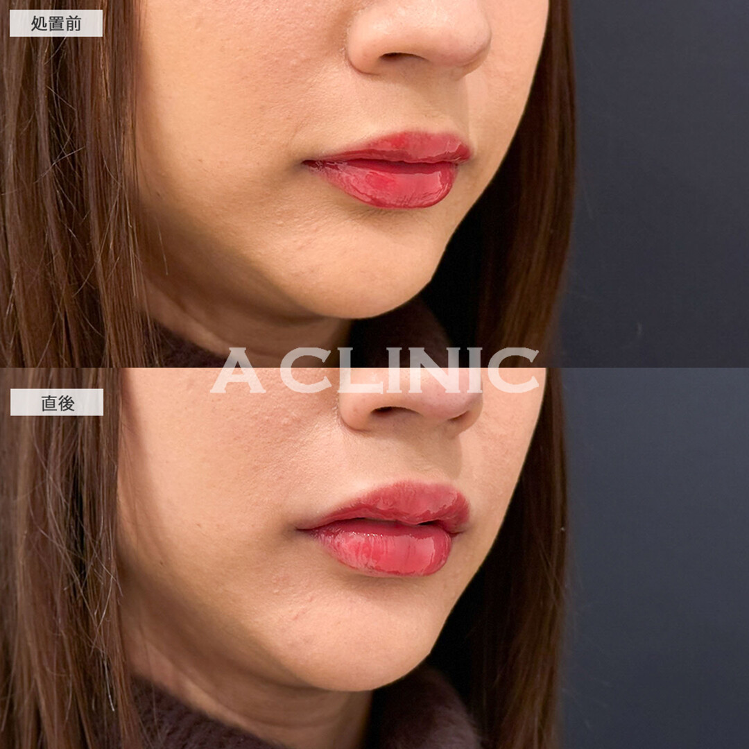 スマイルリップで口角がキュッと上がって可愛さレベルアップしました！こちら処置前と直後の症例です(20代女性)