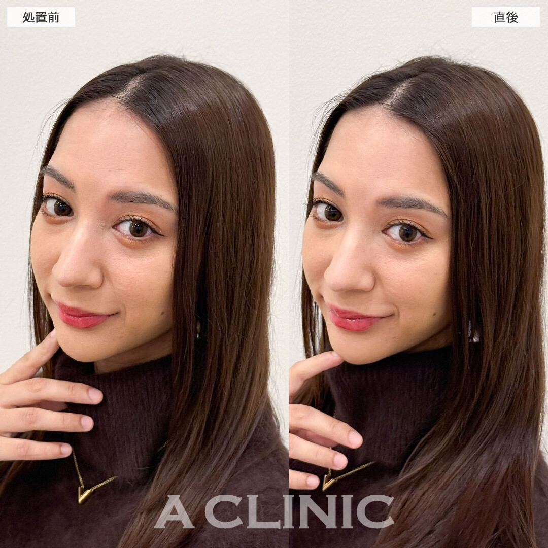 スマイルリップで口角がキュッと上がって可愛さレベルアップしました！こちら処置前と直後の症例です(20代女性)