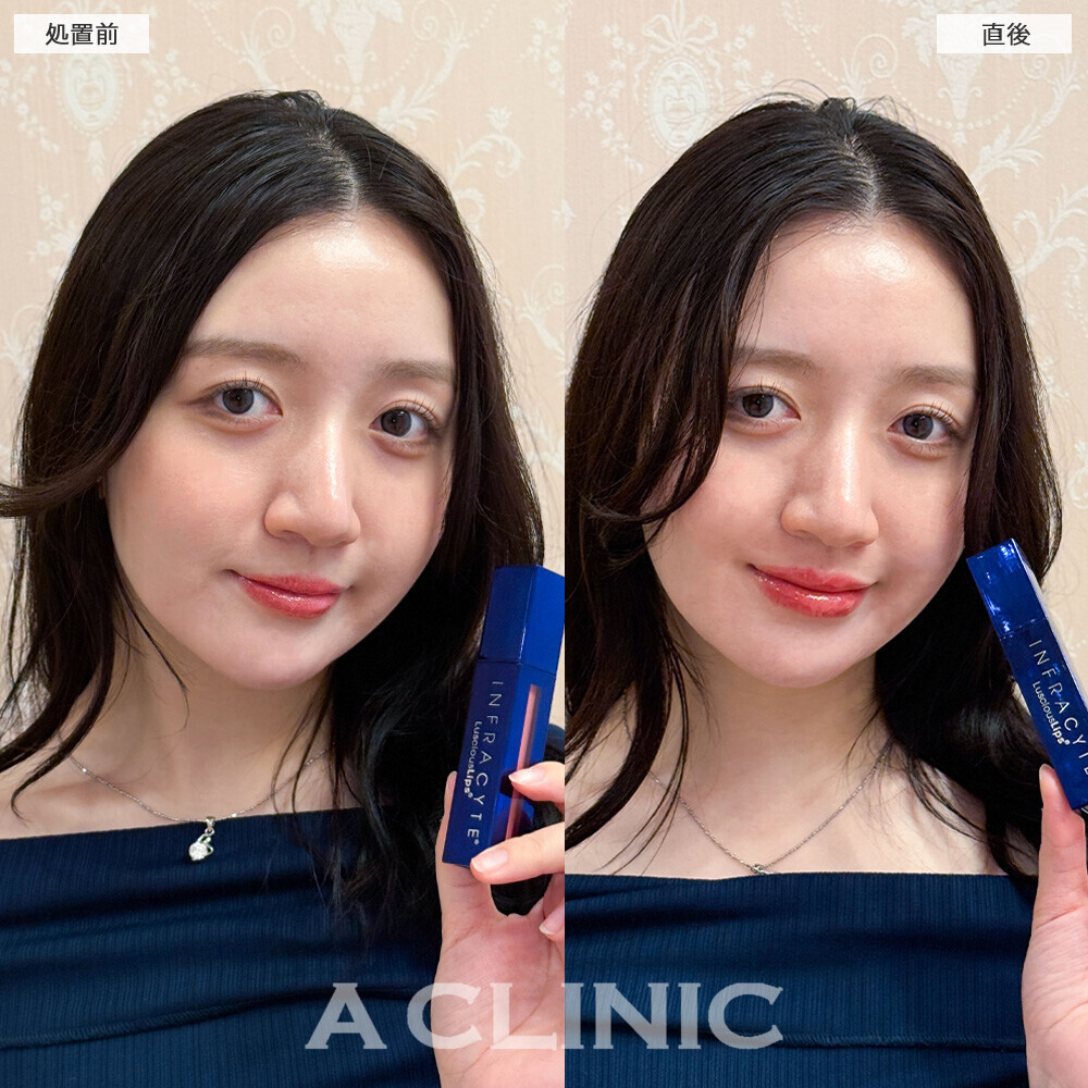 スマイルリップで唇にボリュームが出ることでお顔がハッキリしました！こちら処置前と直後の症例です(20代女性)