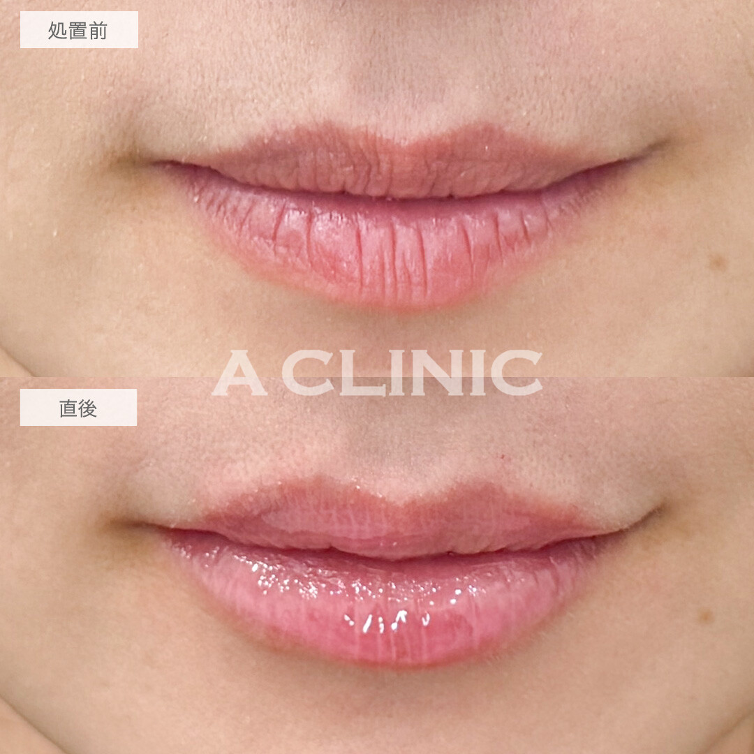 ヒアルロン酸で立体感をプラスしてナチュラルかつ印象的な可愛い唇に！スマイルリップの処置前と直後の症例です(30代女性)