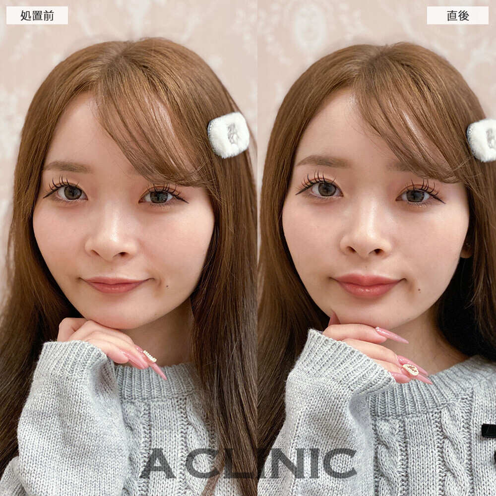 スマイルリップでぷっくり可愛い唇に！こちら処置前と直後の症例です(20代女性)