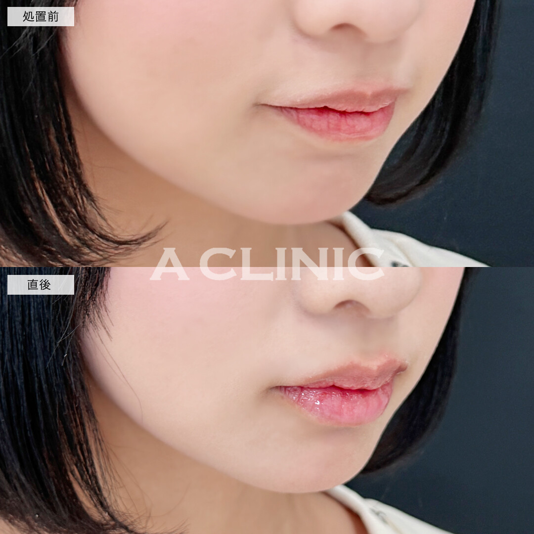 スマイルリップでふっくらM字リップ！こちら処置前と直後の症例です(10代女性)