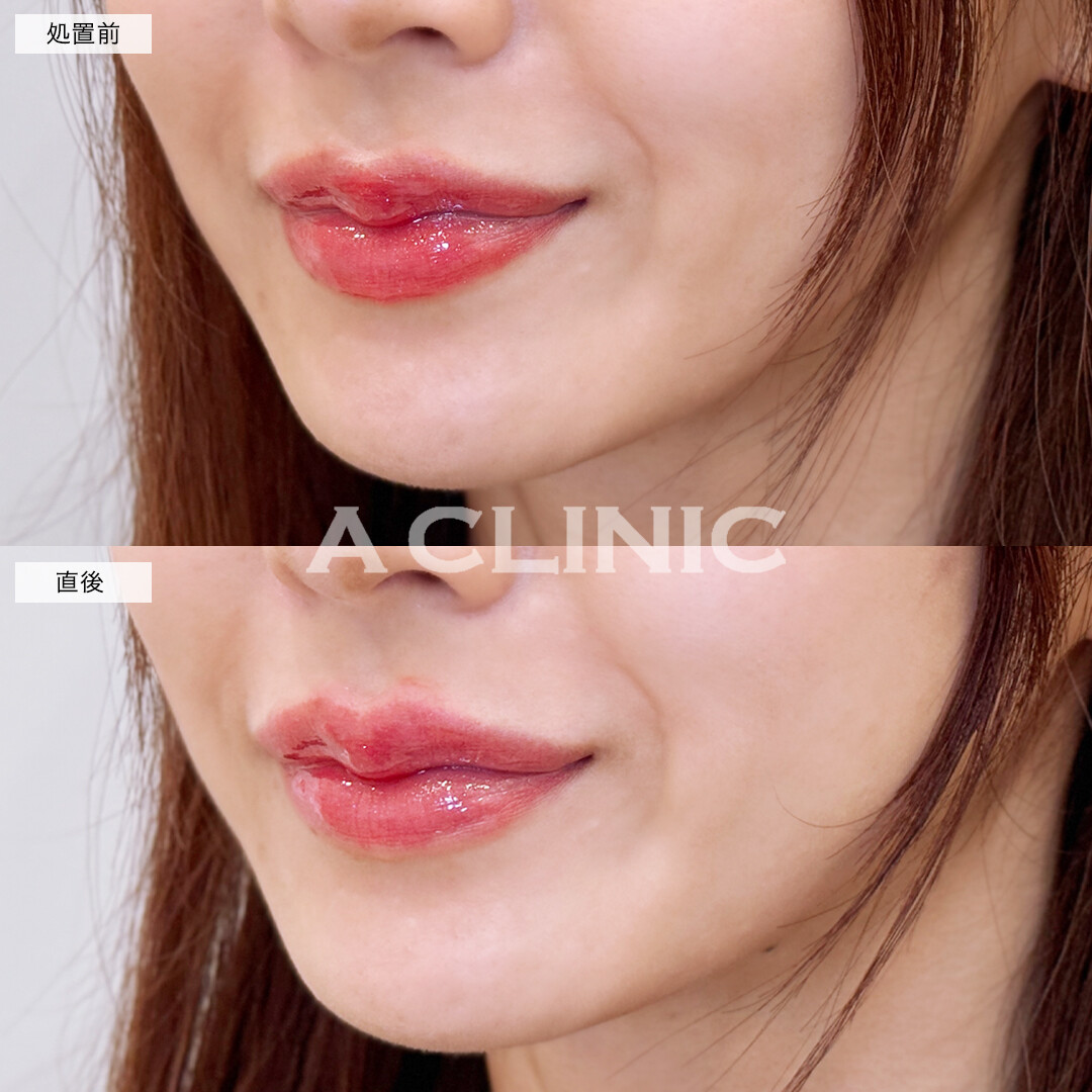 スマイルリップでぷっくり整った美しい唇！こちら処置前と直後の症例です(30女性)