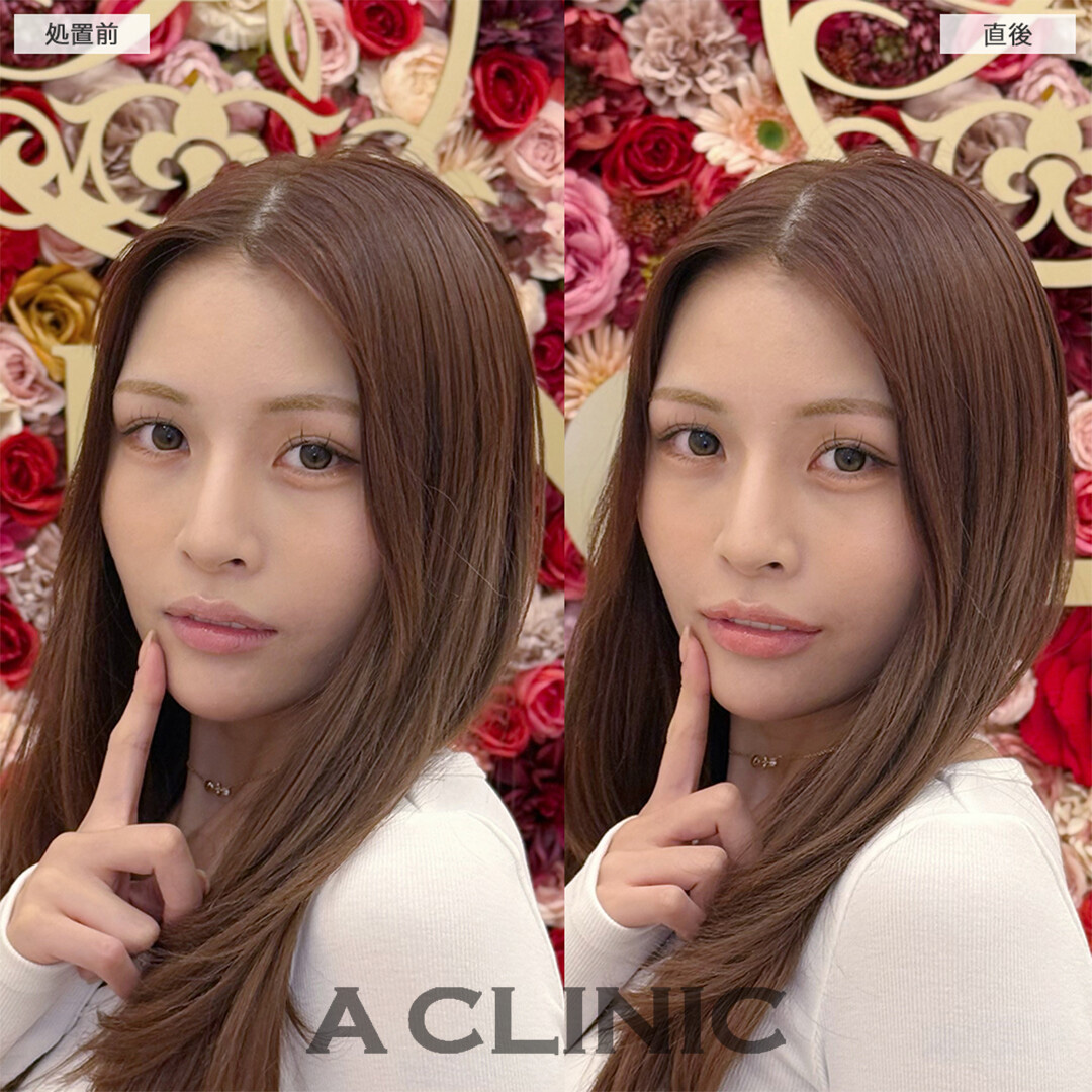 スマイルリップでうるぷる唇ゲット！こちら処置前と直後の症例です(20代女性)