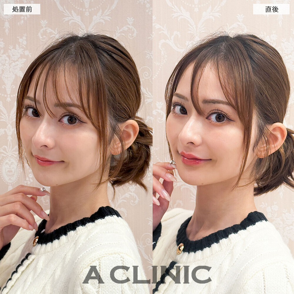 スマイルリップで唇の存在感を出しお顔のバランスを整えます！こちら処置前と直後の症例です(20代女性)