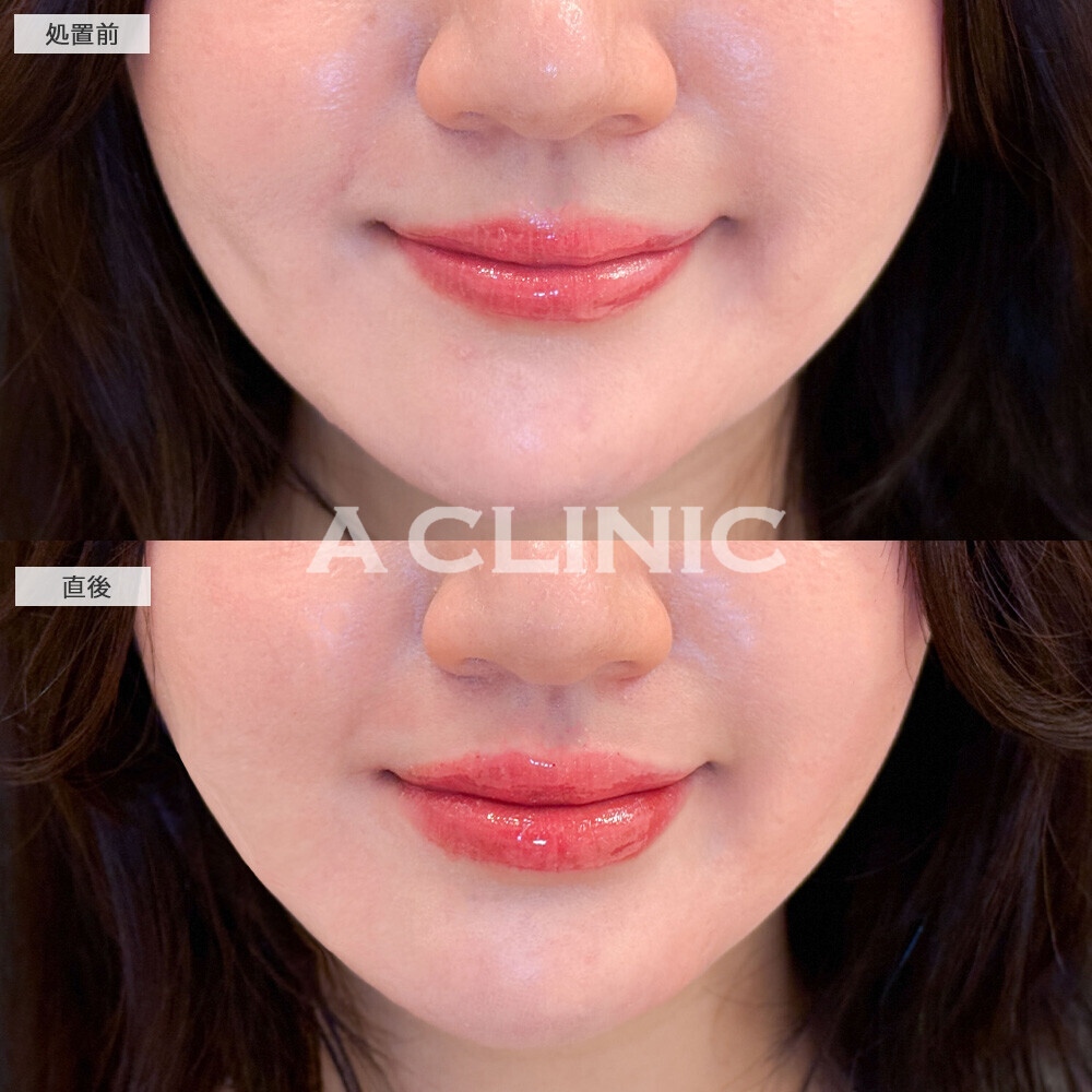 スマイルリップで唇にボリュームが出ることでお顔がハッキリしました！こちら処置前と直後の症例です(20代女性)