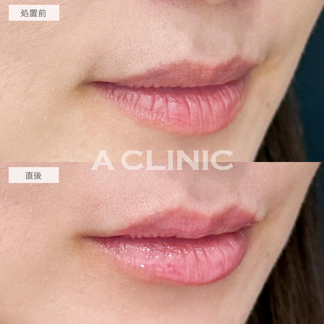 ヒアルロン酸で立体感をプラスしてナチュラルかつ印象的な可愛い唇に！スマイルリップの処置前と直後の症例です(30代女性)