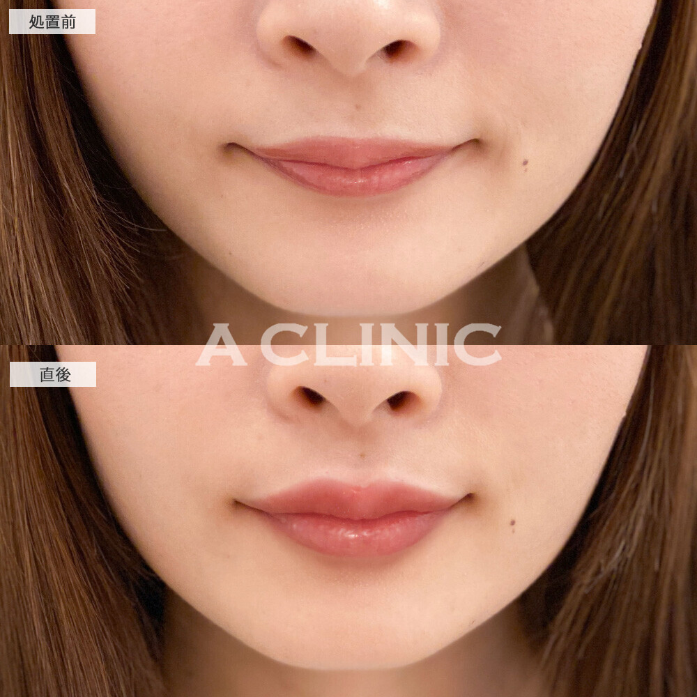 スマイルリップでぷっくり可愛い唇に！こちら処置前と直後の症例です(20代女性)