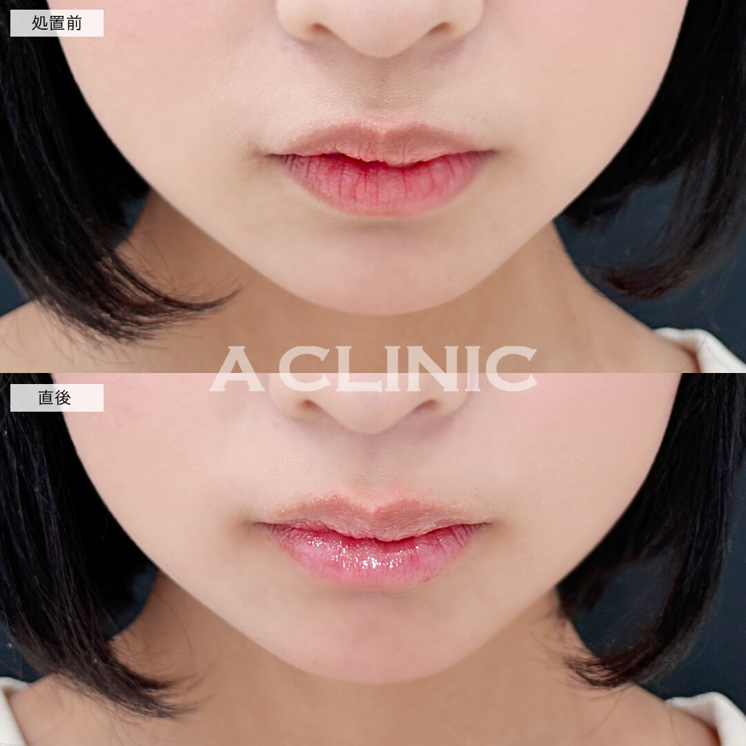 スマイルリップでふっくらM字リップ！こちら処置前と直後の症例です(10代女性)