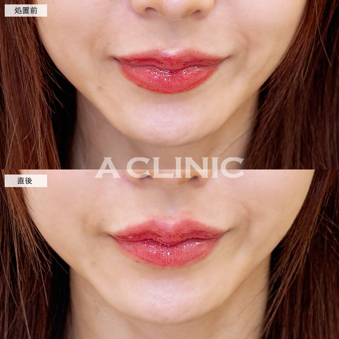 スマイルリップでぷっくり整った美しい唇！こちら処置前と直後の症例です(30女性)