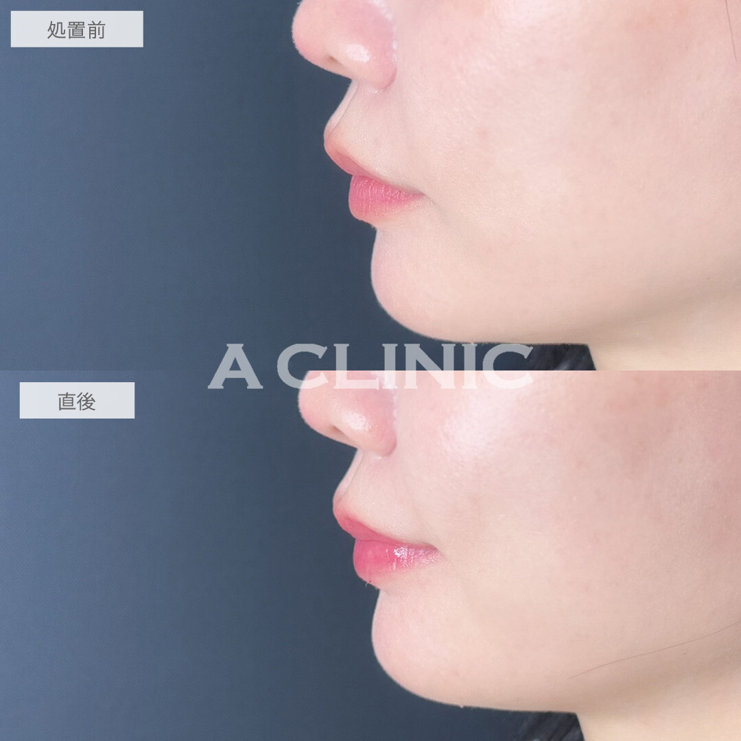 スマイルリップで存在感のあるぷるぷるリップに！こちら処置前と直後の症例です(30代女性)