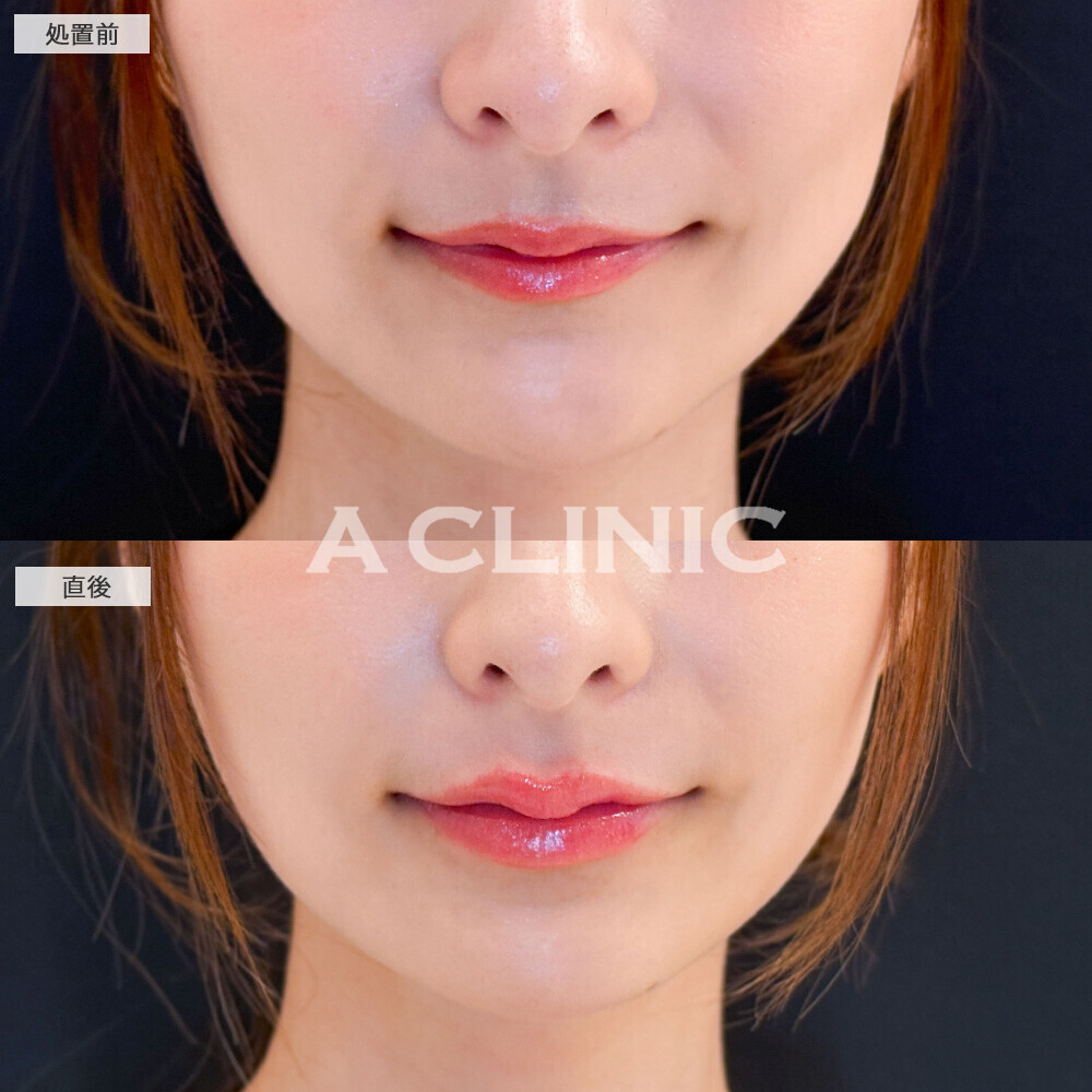 スマイルリップで唇の存在感を出しお顔のバランスを整えます！こちら処置前と直後の症例です(20代女性)