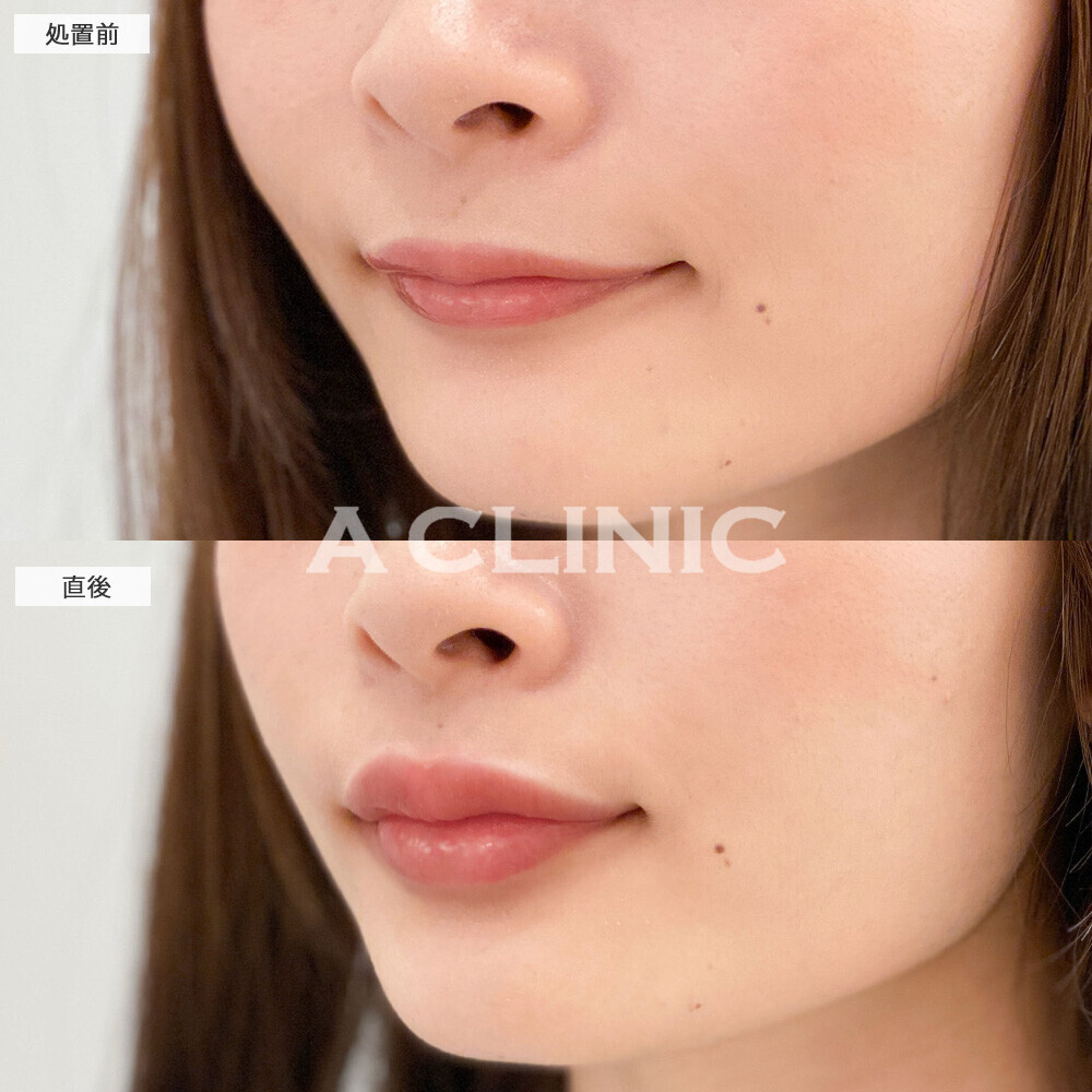 スマイルリップでぷっくり可愛い唇に！こちら処置前と直後の症例です(20代女性)