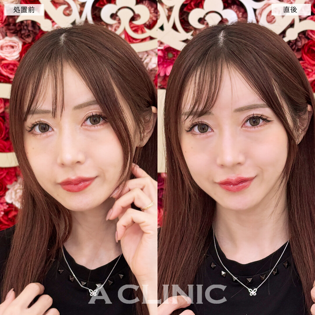 スマイルリップでぷっくり整った美しい唇！こちら処置前と直後の症例です(30女性)