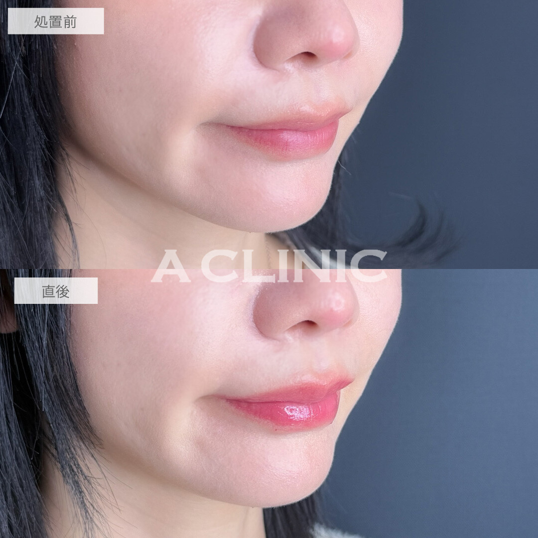 スマイルリップで存在感のあるぷるぷるリップに！こちら処置前と直後の症例です(30代女性)