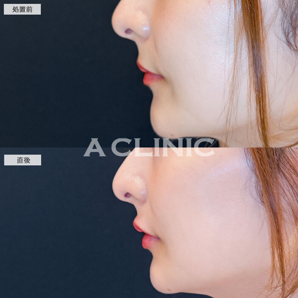 スマイルリップで唇の存在感を出しお顔のバランスを整えます！こちら処置前と直後の症例です(20代女性)