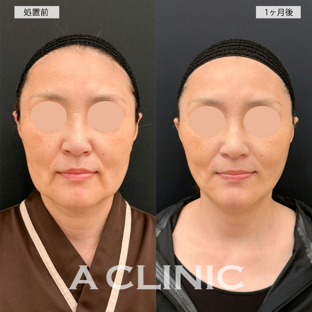 A式美肌たるみ切開で長年のお悩みのたるみが改善され産まれ変わることができました！こちら処置前と1ヶ月後の症例です(50代女性)