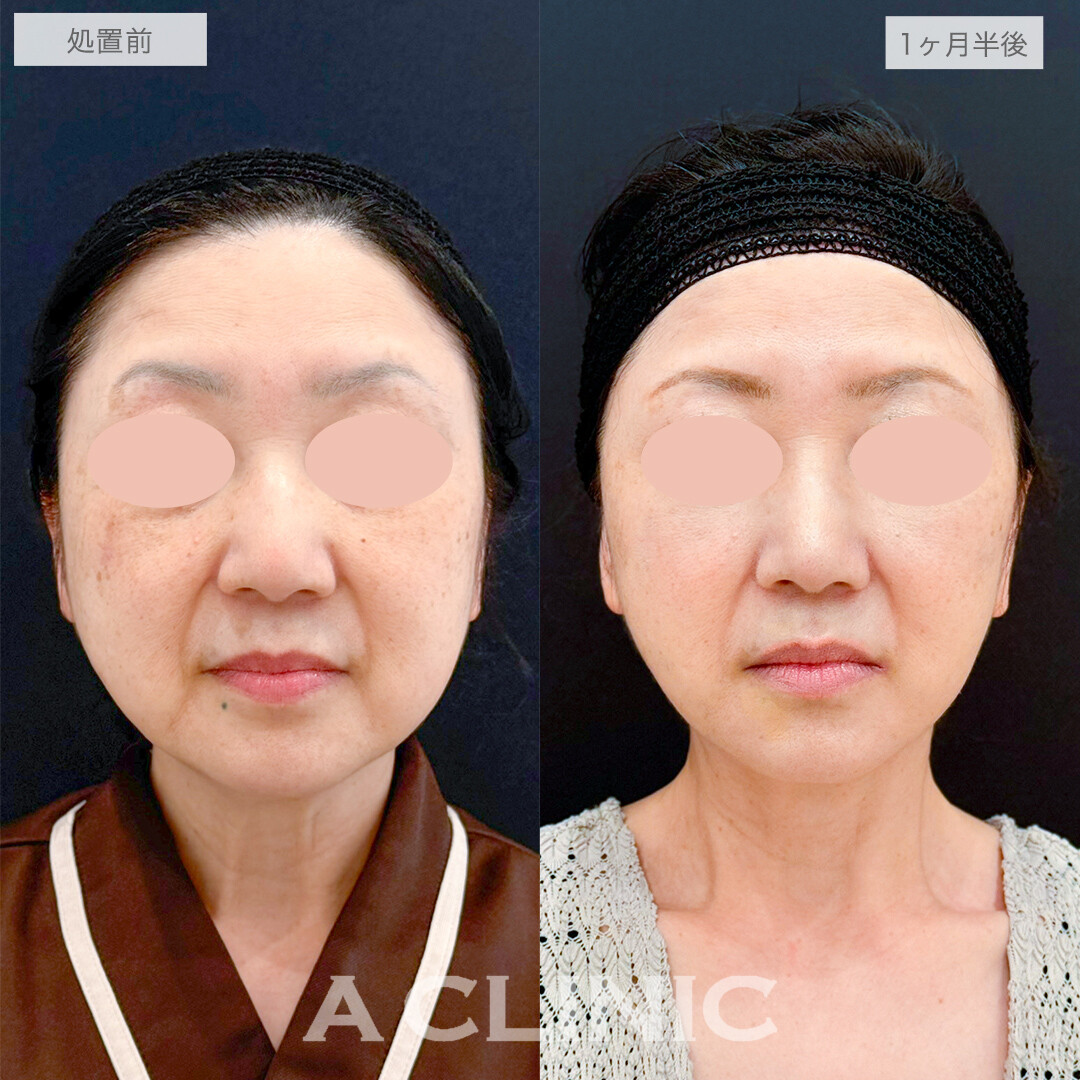 フェイスリフトで若返りながら小顔になれる！処置前と1ヶ月半後の症例です(50代女性)