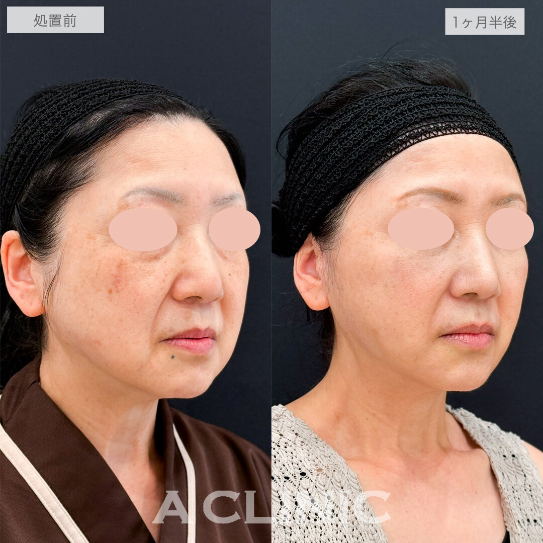 フェイスリフトで若返りながら小顔になれる！処置前と1ヶ月半後の症例です(50代女性)