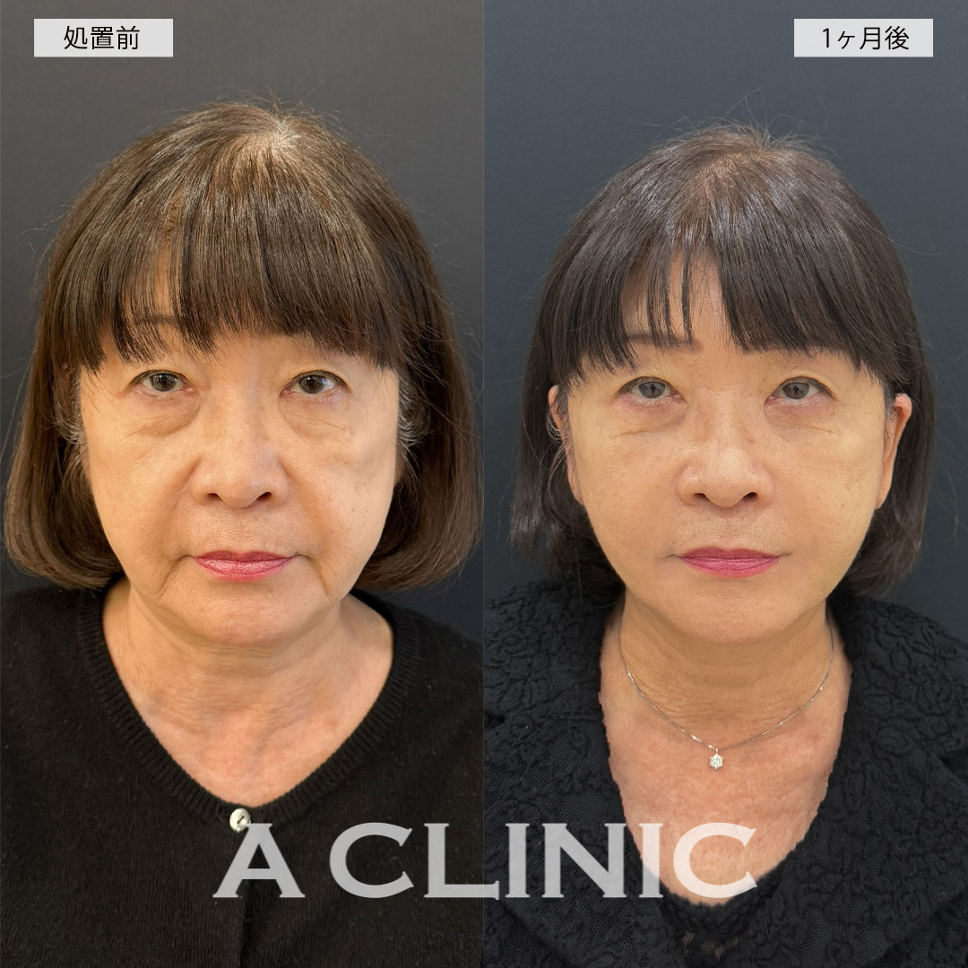 複合施術でお顔のたるみが改善され若返りに成功しました！こちら処置前と1ヶ月後の症例です(60代女性)