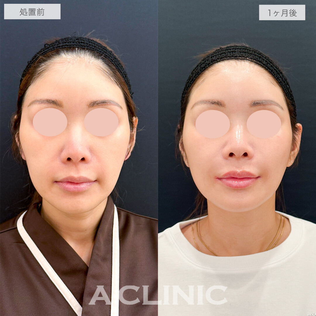 A式美肌たるみ切開でシャープなフェイスラインに！処置前と1ヶ月後の症例です(40代女性)