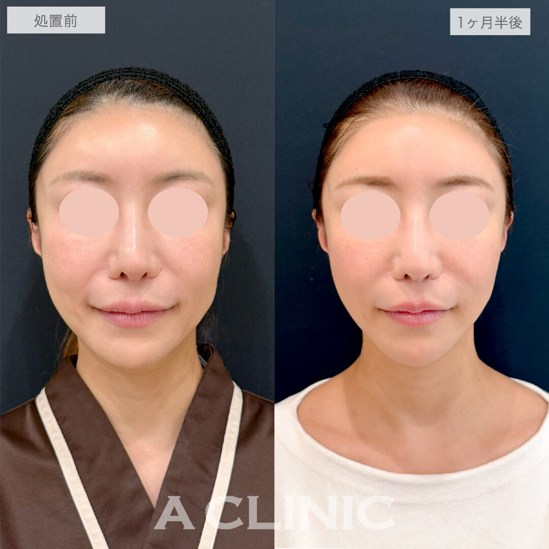 A式美肌たるみ切開で若々しいフェイスラインを取り戻す！処置前と1ヶ月半後の症例です(40代女性)