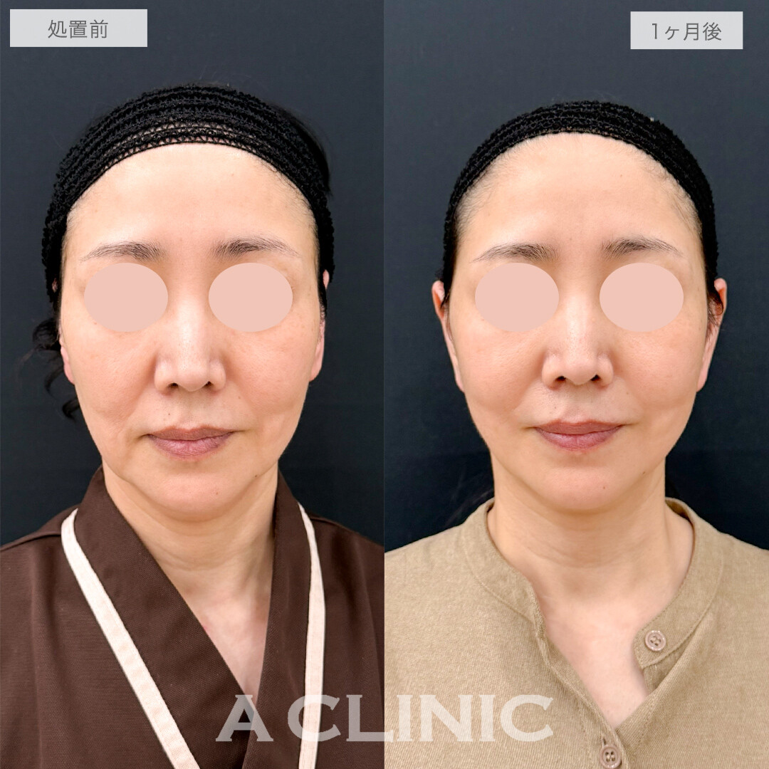 A式美肌たるみ切開で-10歳若返り！処置前と1ヶ月後の症例です(50代女性)