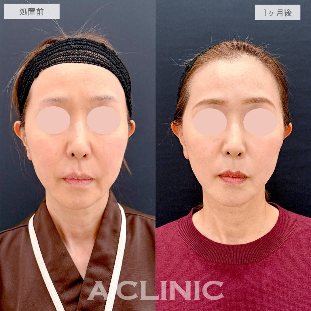 A式美肌たるみ切開でたるみのボコつきも無くなりツルンとした輪郭に！処置前と1ヶ月後の症例です(50代女性)