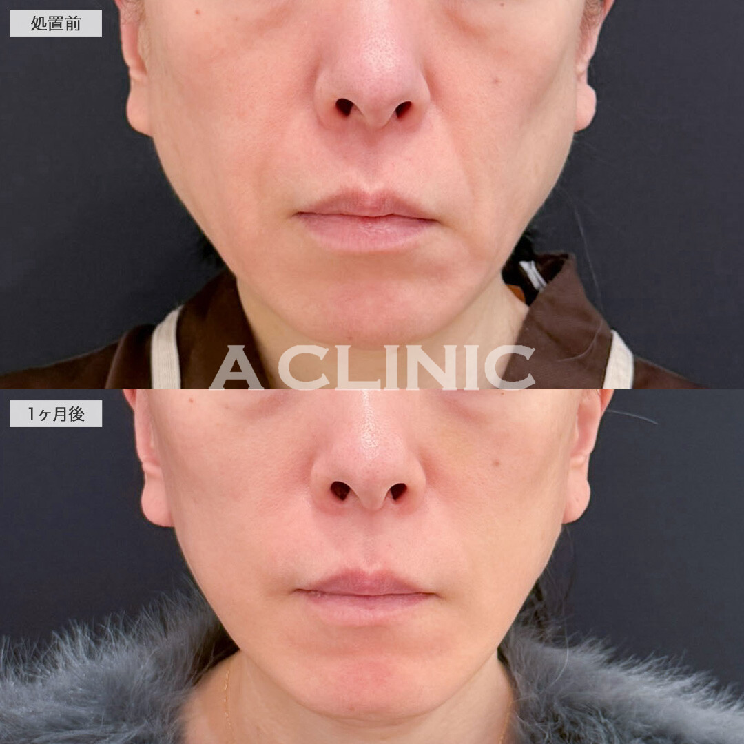 A式美肌たるみ切開と1day小顔脂肪吸引で周りにばれずに若返り成功！こちら処置前と1ヶ月後の症例です(40代女性)