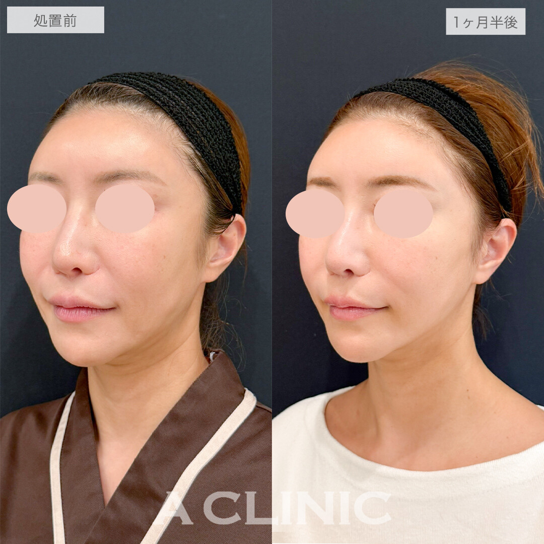 A式美肌たるみ切開で若々しいフェイスラインを取り戻す！処置前と1ヶ月半後の症例です(40代女性)