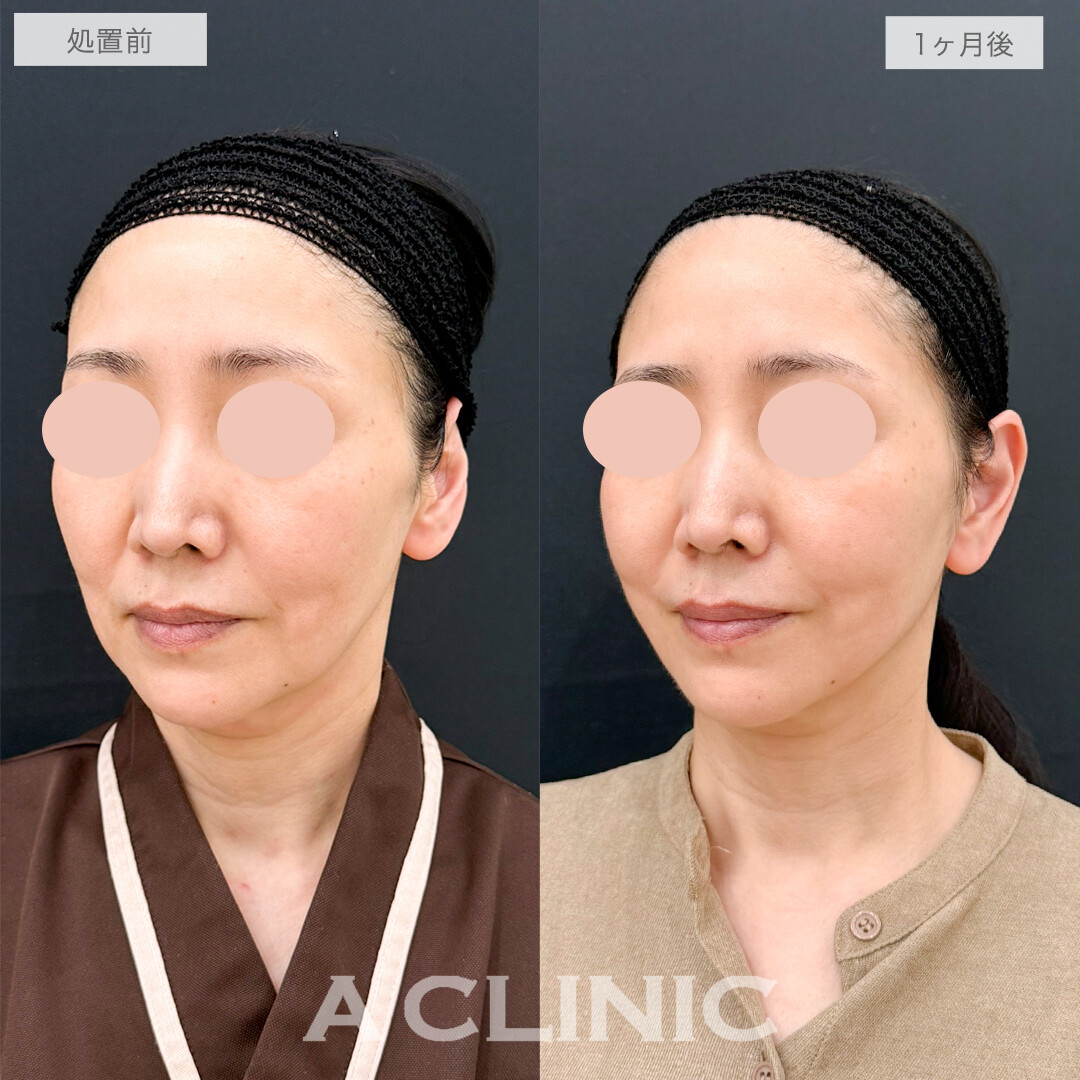 A式美肌たるみ切開で-10歳若返り！処置前と1ヶ月後の症例です(50代女性)