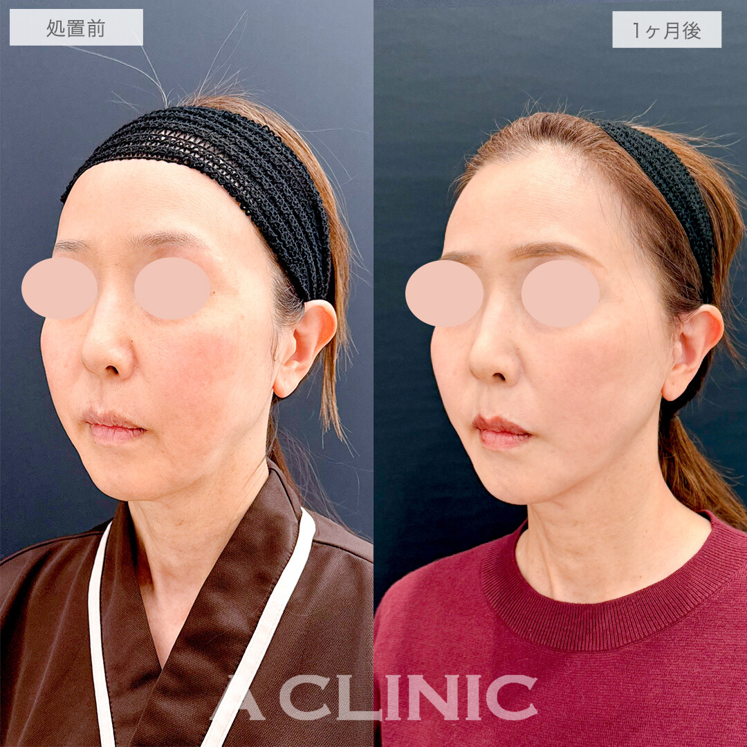 A式美肌たるみ切開でたるみのボコつきも無くなりツルンとした輪郭に！処置前と1ヶ月後の症例です(50代女性)