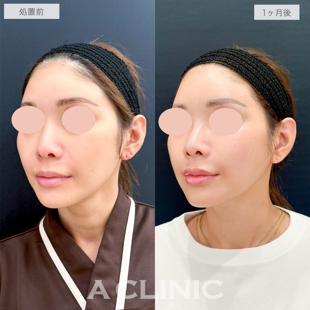 A式美肌たるみ切開でシャープなフェイスラインに！処置前と1ヶ月後の症例です(40代女性)