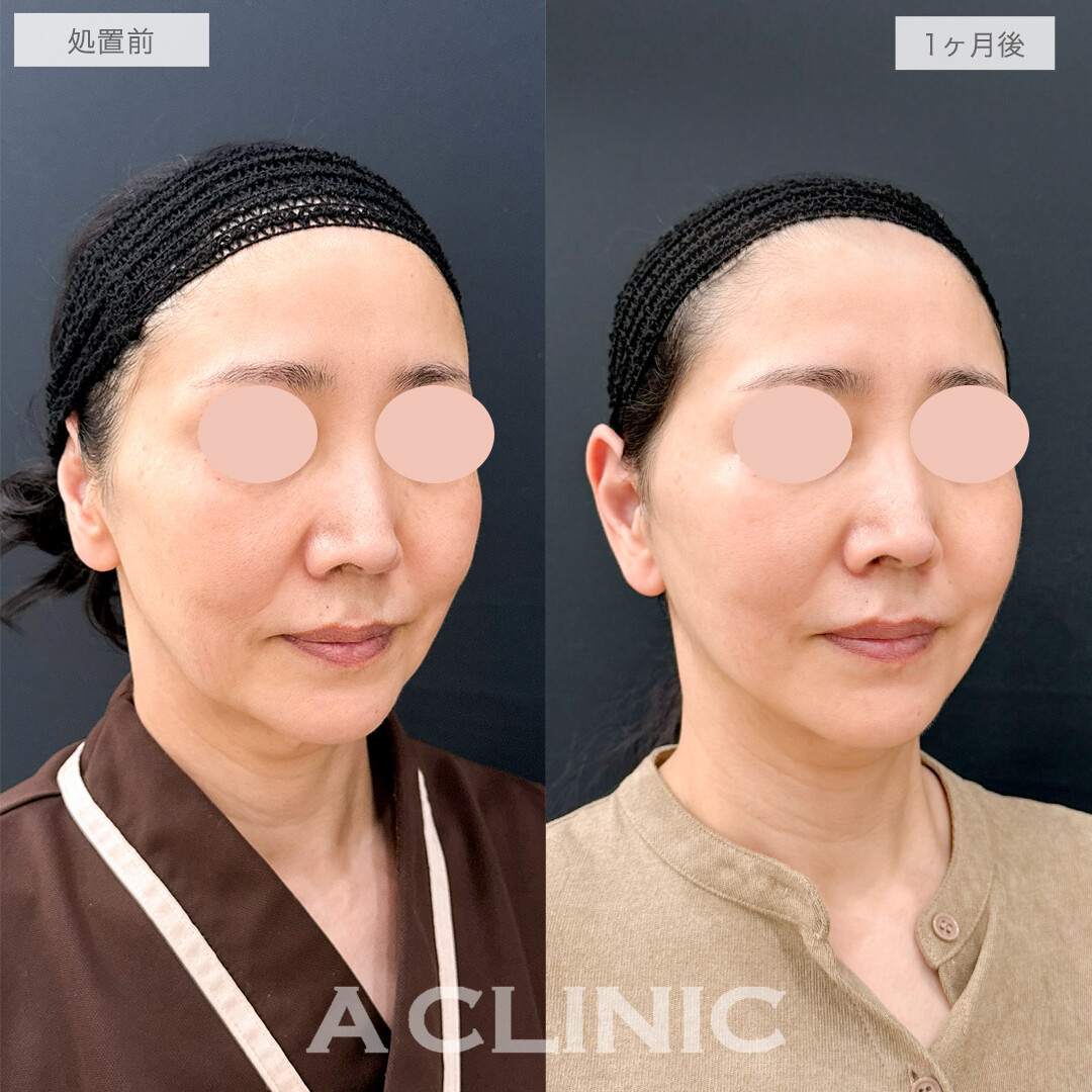 A式美肌たるみ切開で-10歳若返り！処置前と1ヶ月後の症例です(50代女性)